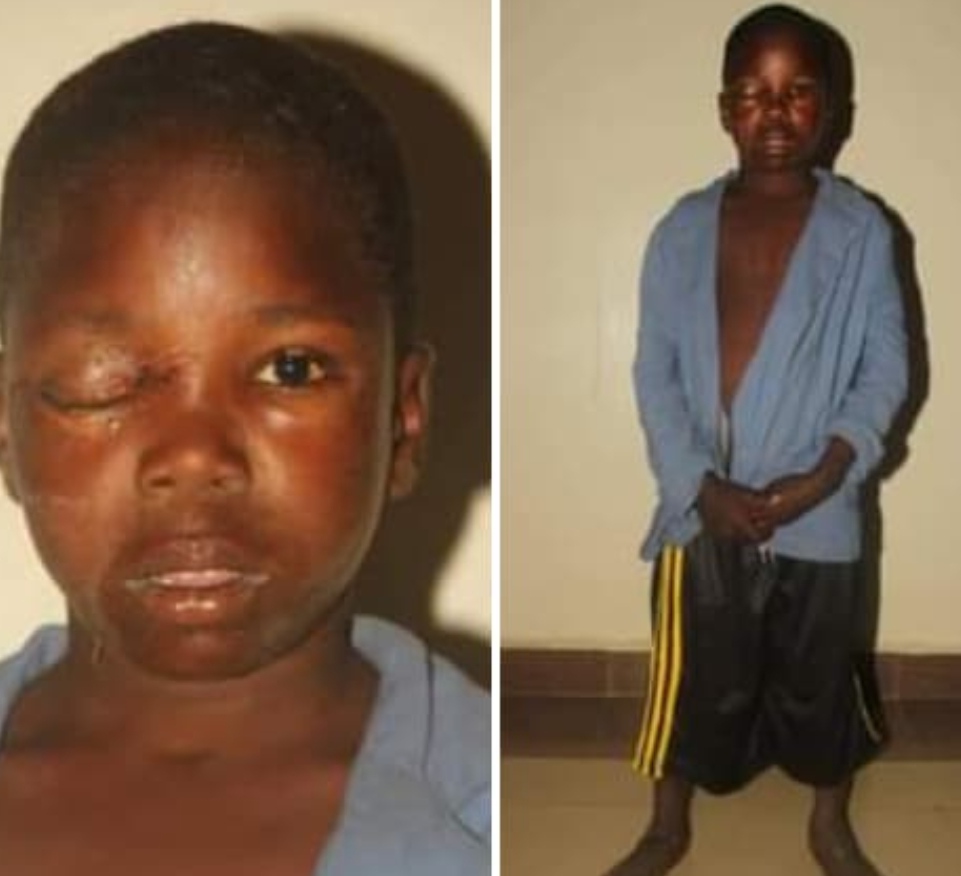 Anguish Of A 12-Year-Old Boy’s Whose Eye Was Plucked Out By Dare Devil Ritualists