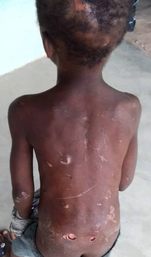 7 Year- Old Brutalized By A Childless Mother, Over House Chores, Battles Kidney, Liver Enlargement