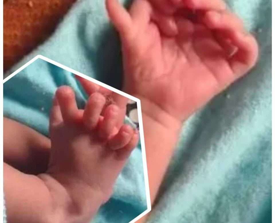 Amazing Story Of Baby Born With 7 Fingers On Each Hand, 6 Toes On Each Foot