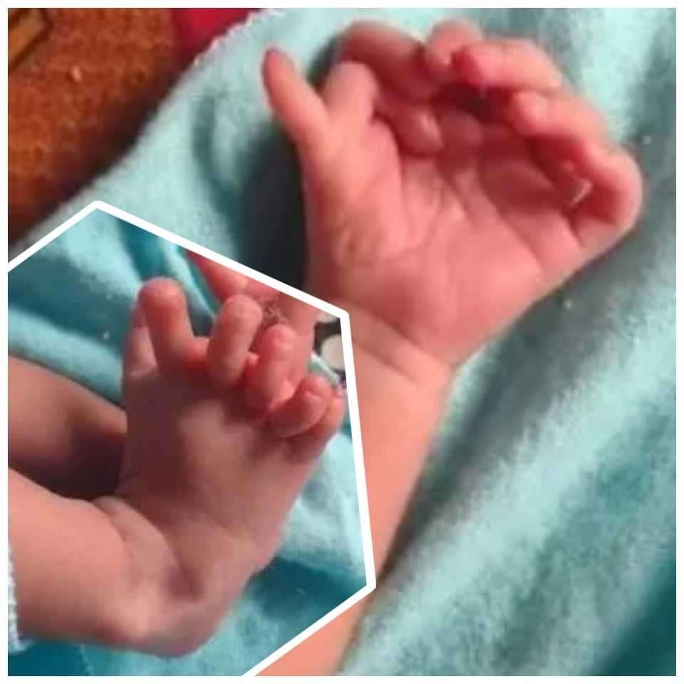 Amazing Story Of Baby Born With 7 Fingers On Each Hand, 6 Toes On Each Foot